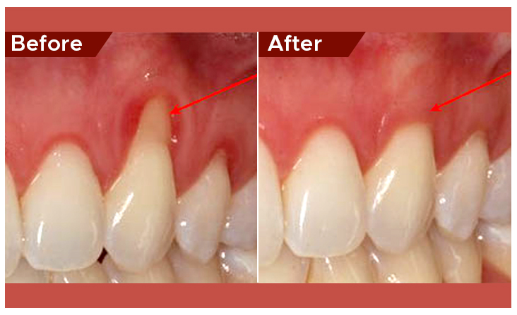 gum disease treatment in abu dhabi